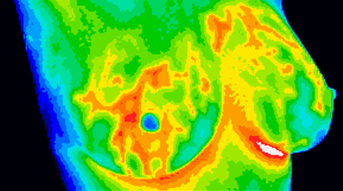 Colour-coded side-profile breast thermogram