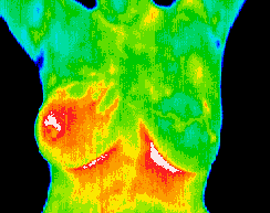 Colour-coded clinical breast thermogram