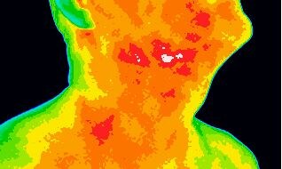 Colour-coded thermal image of the neck and lower face